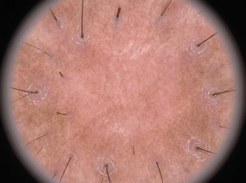 Trichoscopy view showing characteristic features of CCCA including follicular dropout and perifollicular scaling